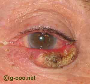 Tumor no olho - Entenda sobre tumores de pálpebra aqui!